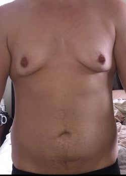 Before Image: FtM DI top surgery for gender affirmation with body contouring (lower abdominoplasty and liposuction) - front