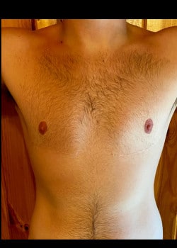 After Image: FtM double incision mastectomy and nipple grafting for gender confirming top surgery - front
