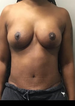 After Image: Mommy Makeover with Tummy Tuck and Breast Lift - front