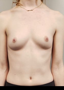Before Image: Breast Augmentation with silicone breast implants - front