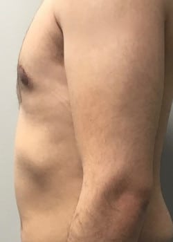 After Image: Gynecomastia Reduction (male breast reduction) in Cleveland, Ohio - other