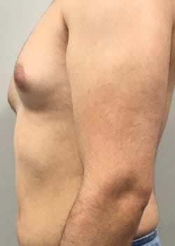 Before Image: Gynecomastia Reduction (male breast reduction) in Cleveland, Ohio - other