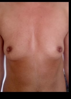 Before Image: FtM Gender Affirmation Peri-Areolar Top Surgery - front