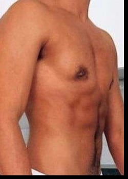 After Image: FtM Gender Affirmation Peri-Areolar Top Surgery - front