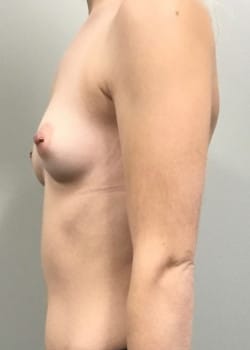Before Image: Breast Augmentation with IDEAL Structured Saline Breast Implants - other