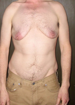 Before Image: FtM DI Top Surgery - front