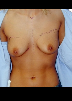 Before Image: Breast Augmentation with saline breast implants - front