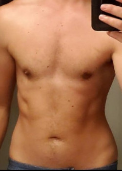 After Image: FtM Top Surgery before and after via a peri-areolar approach with simultaneous nipple reduction - front