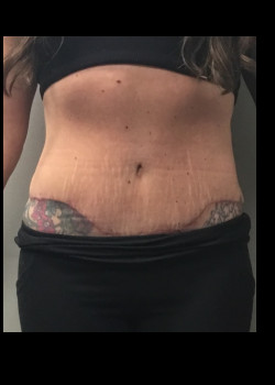 After Image: Tummy Tuck and Flank Liposuction - front