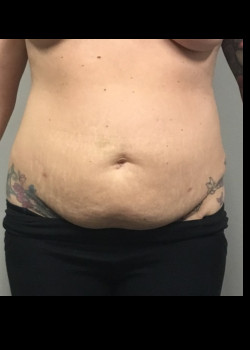 Before Image: Tummy Tuck and Flank Liposuction - front