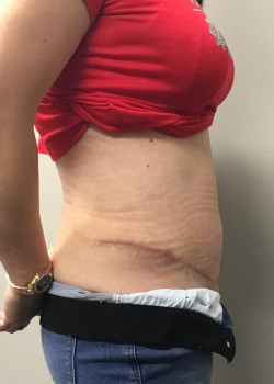 After Image: Abdominoplasty and muscle tightening and trunk liposuction - other
