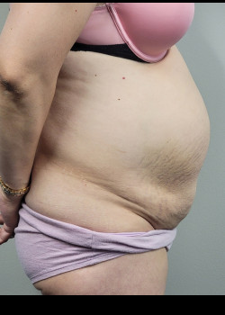 Before Image: Abdominoplasty and muscle tightening and trunk liposuction - other