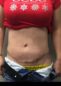 After Image: Abdominoplasty and muscle tightening and trunk liposuction - front