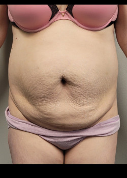 Before Image: Abdominoplasty and muscle tightening and trunk liposuction - front