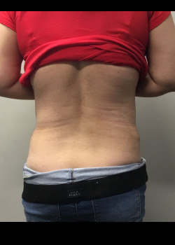 After Image: Abdominoplasty and muscle tightening and trunk liposuction - back