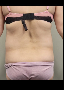 Before Image: Abdominoplasty and muscle tightening and trunk liposuction - back