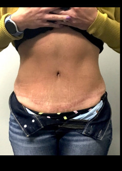 After Image: Tummy tuck with flank liposuction before and after - front