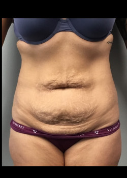 Before Image: Tummy tuck with flank liposuction before and after - front