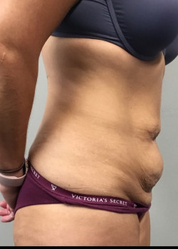 Before Image: Tummy tuck with flank liposuction before and after - front