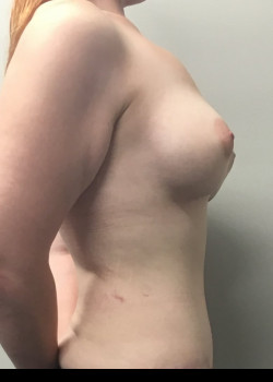 After Image: Tummy Tuck and Breast Augmentation with Saline Breast Implants - other