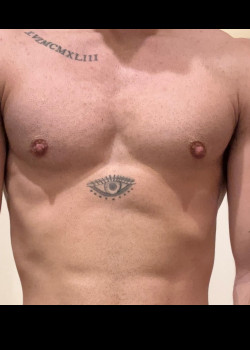 After Image: FtM Peri Areolar Gender Affirmation Top Surgery - front