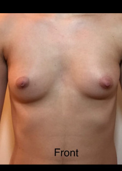 Before Image: FtM Peri Areolar Gender Affirmation Top Surgery - front