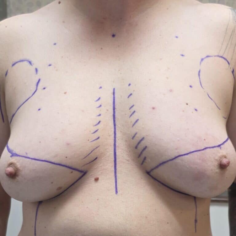FtM Di markings