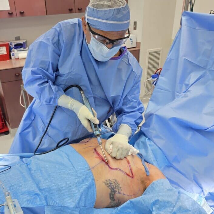 Top Surgery Liposuction