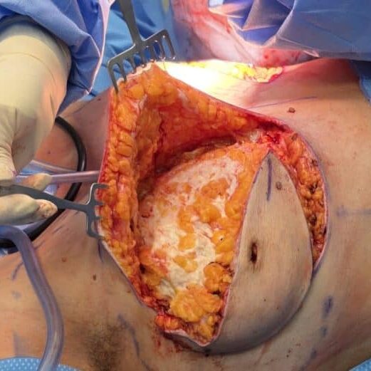 Reomoval of breast tissue