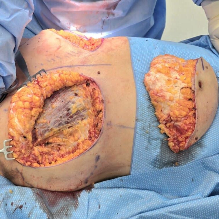 FtM Mastectomy