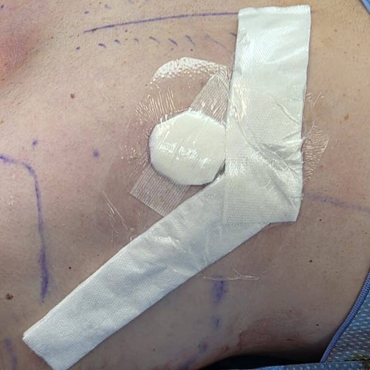 Top Surgery Dressings applied in the OR