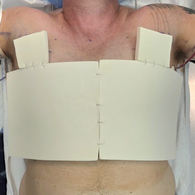 Foam is Applied to the Chest after Top Surgery