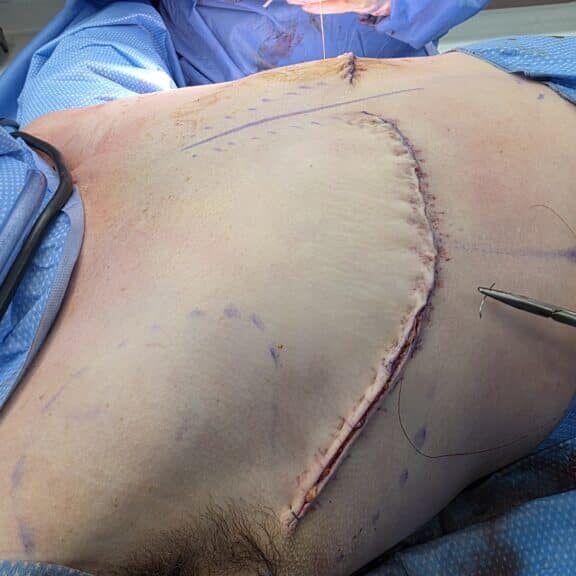 Closing the top surgery incision