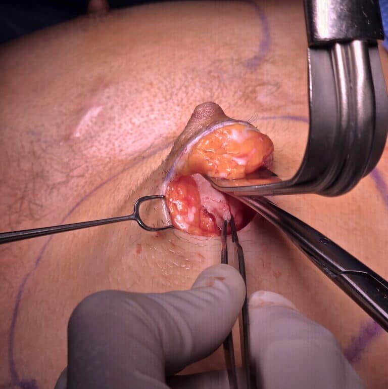 Periareolar mastectomy