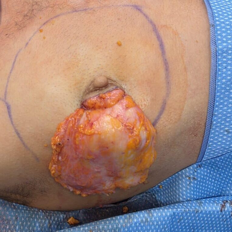Periareolar mastectomy