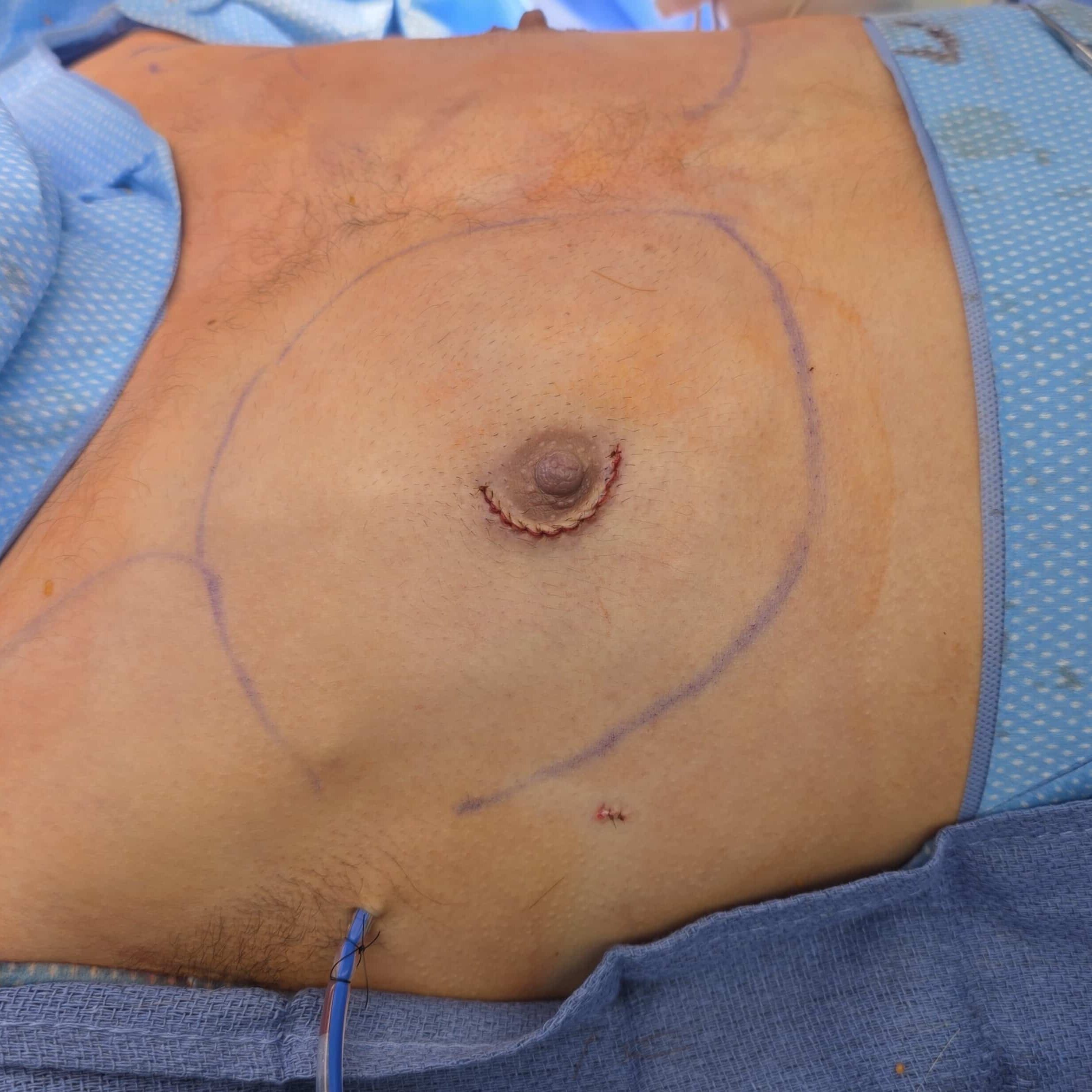 Peri procedure