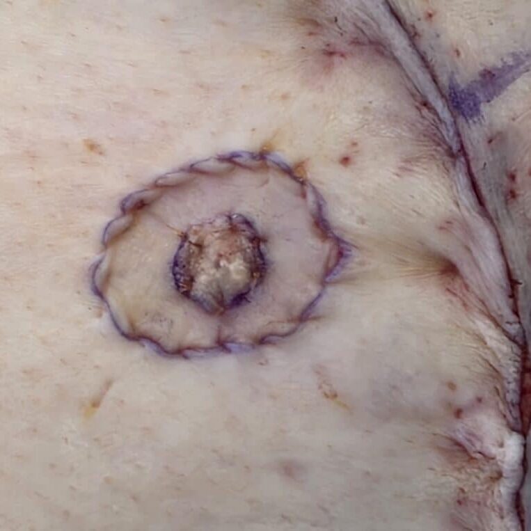 Separate areolar and nipple graft