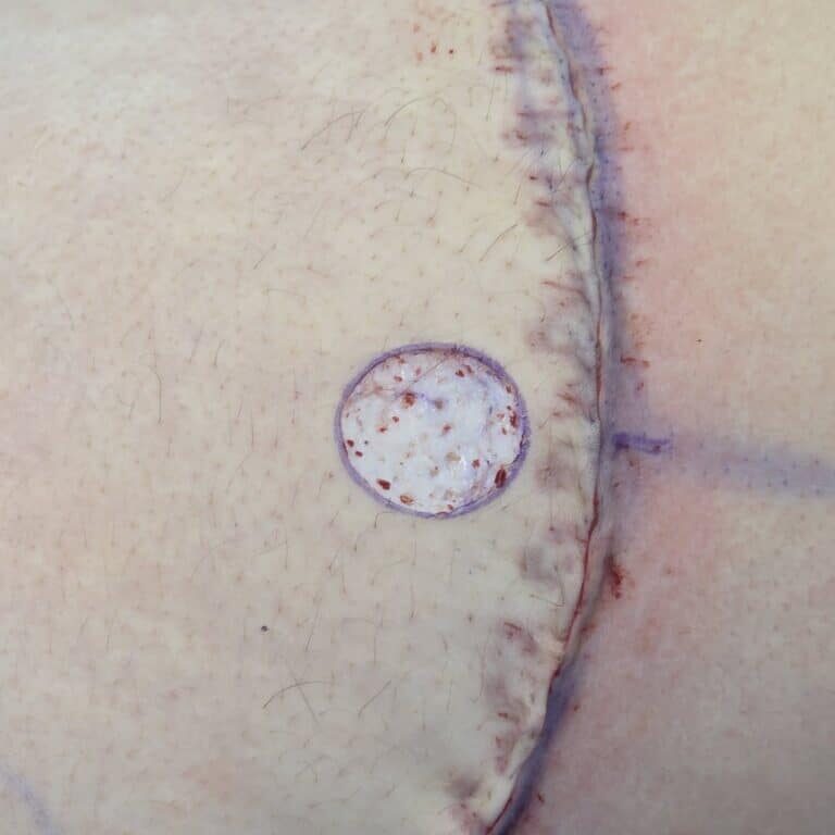 De-epithelialization of nipple graft recipient site