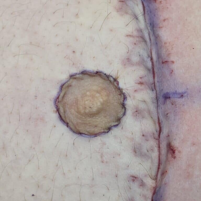 DI nipple graft