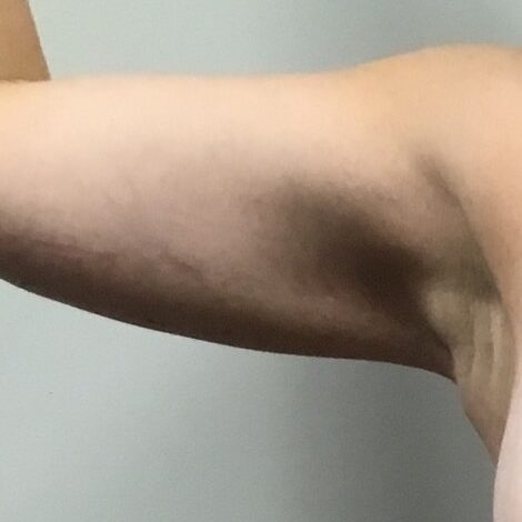 Brachioplasty lift after