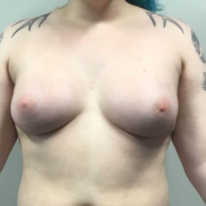 Trans feminine breast augmentation before and after
