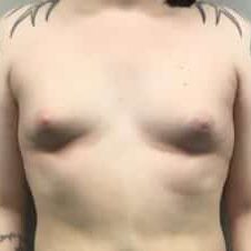 Trans feminine breast augmentation before and after