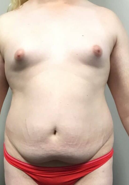 MtF Breast aug and tummy tuck before