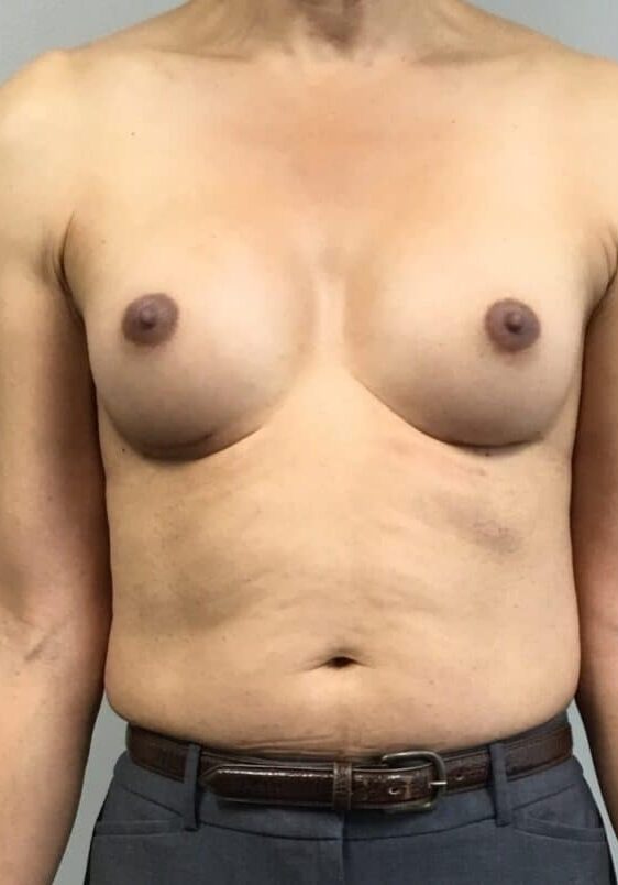 MtF breast augmentatin before and after 2