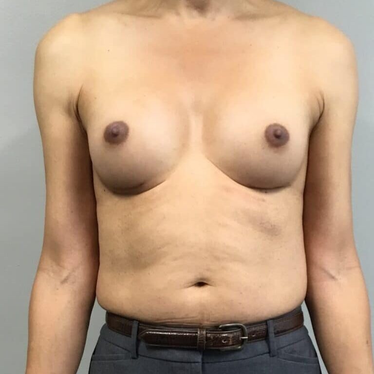 MtF breast augmentatin before and after 2
