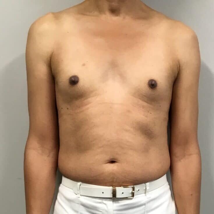 MtF breast augmentatin before and after