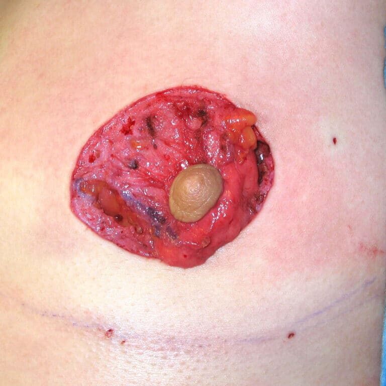 Peri procedure