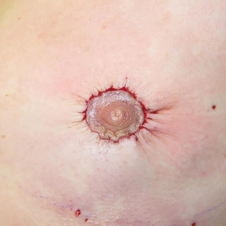 Peri procedure