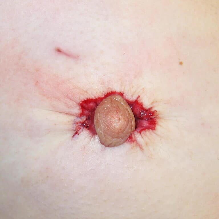 Peri procedure