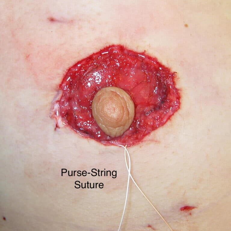 Peri procedure